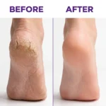 ELLGY Plus Cracked Heel Cream - Result Skinzo Bd