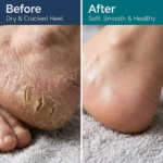 FootEase by Watsons Cracked Heel Cream - Result By Skinzo Bd